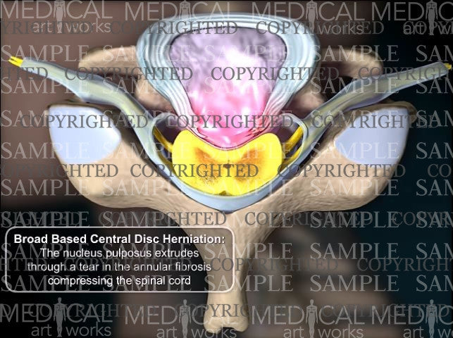 Cervical spine broad based central disc herniation - Female