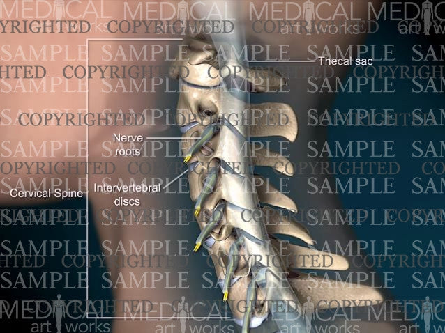 Cervical spine central disc herniation - Female