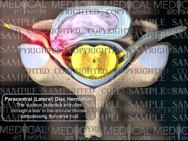 Cervical spine paracentral (lateral) disc herniation - Female