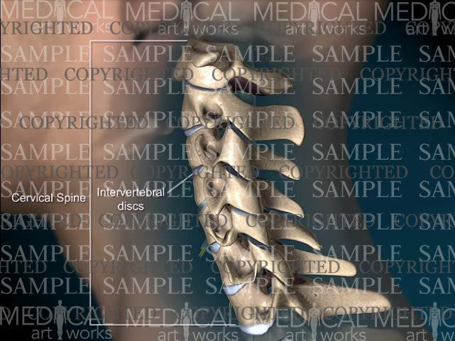 Cervical spine posterior central disc herniation - Male