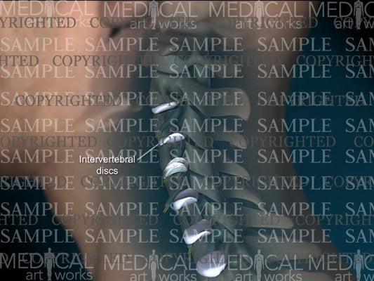 Cervical spine central disc herniation - Male