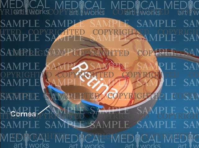 Anatomy of the right eye - retinopathy of prematurity (ROP) Animation