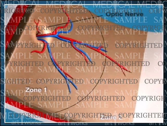 The zones of retina and normal retinal vessel growth on a premature baby