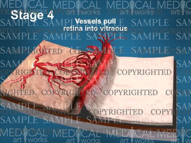 The 5 Stages Of Retinopathy Of Prematurity - ROP