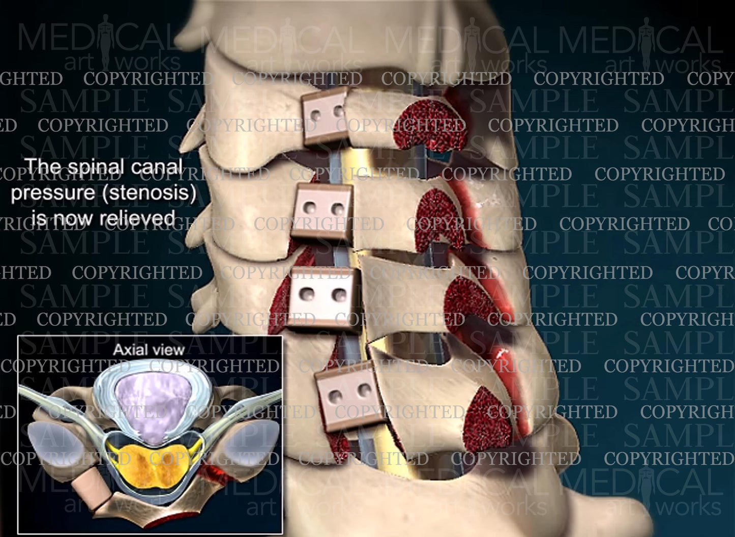 Cervical open door laminoplasty - C3, C4, C5, C6