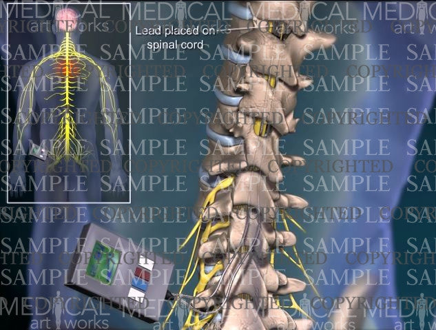 Spinal Cord Stimulator Implant