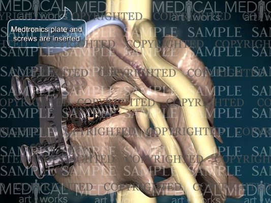 Cervical spine artificial disc replacement and plate fusion
