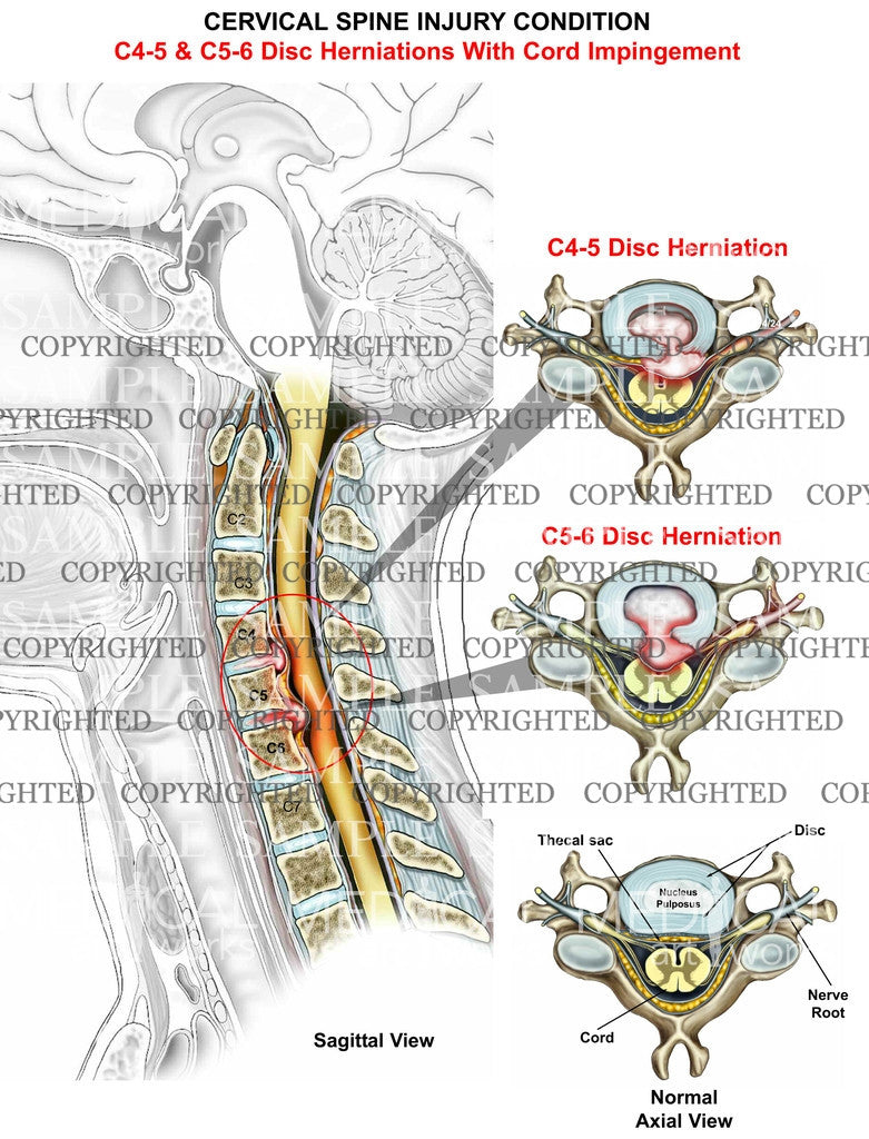 cervical disc herniation, 2 level impingement