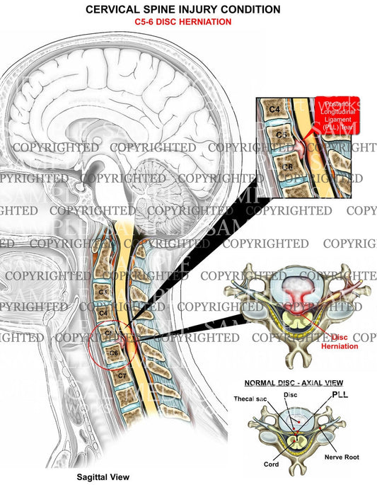 C5-6 disc herniation2 - central