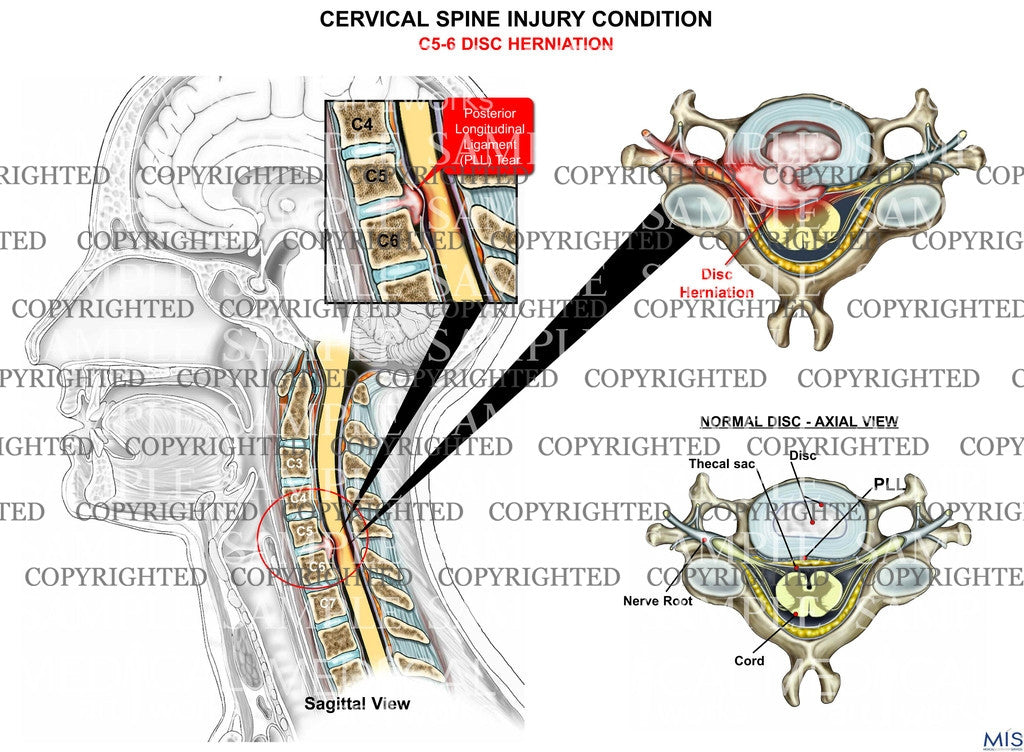 C5-6 disc herniation - PLL tear