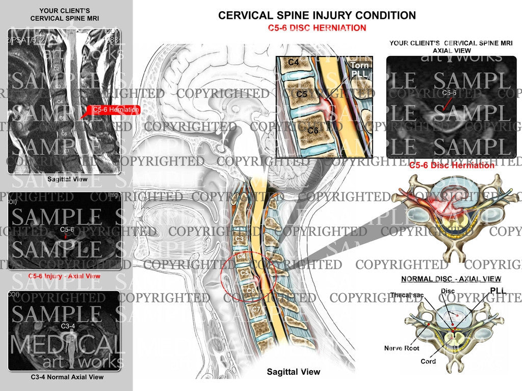 C5-6 disc herniation + MRIs