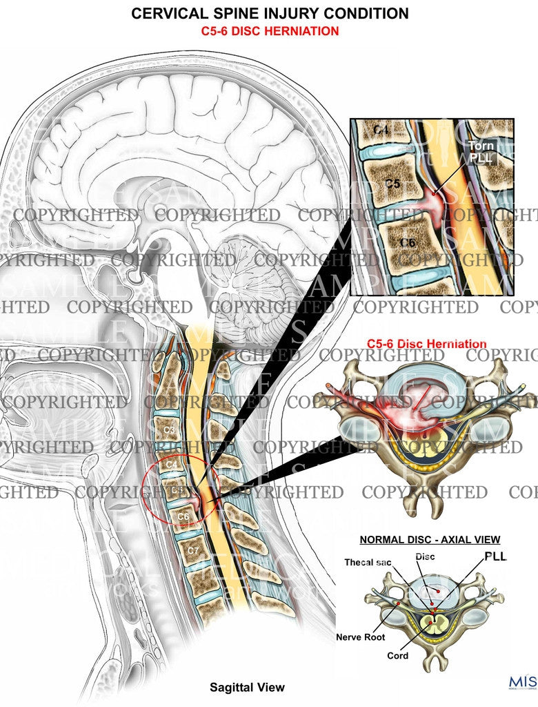 C5-6 disc herniation - broad-based