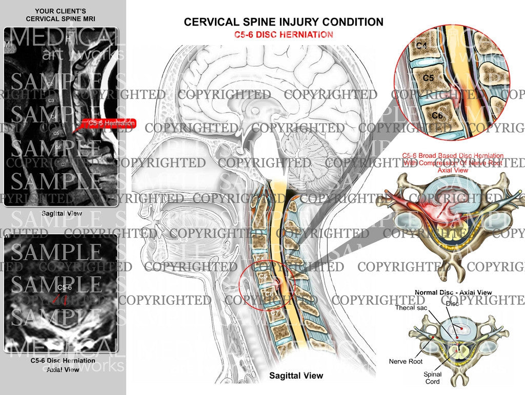 C5-6 disc herniation + MRI