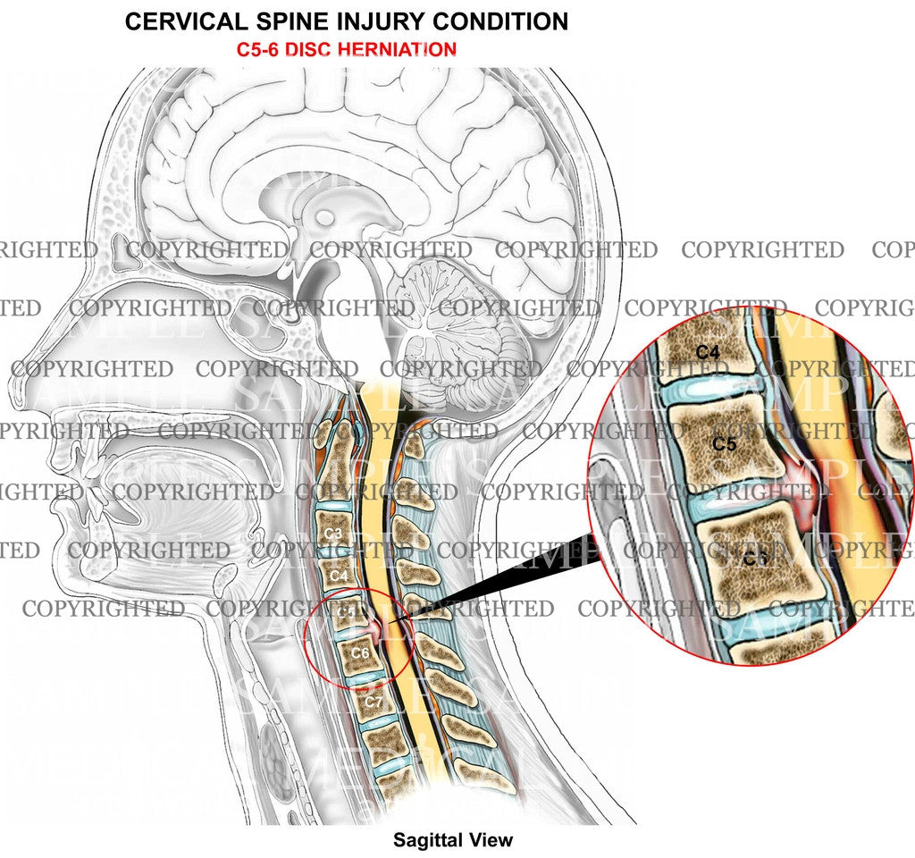 C5-6 disc herniation - sagittal view