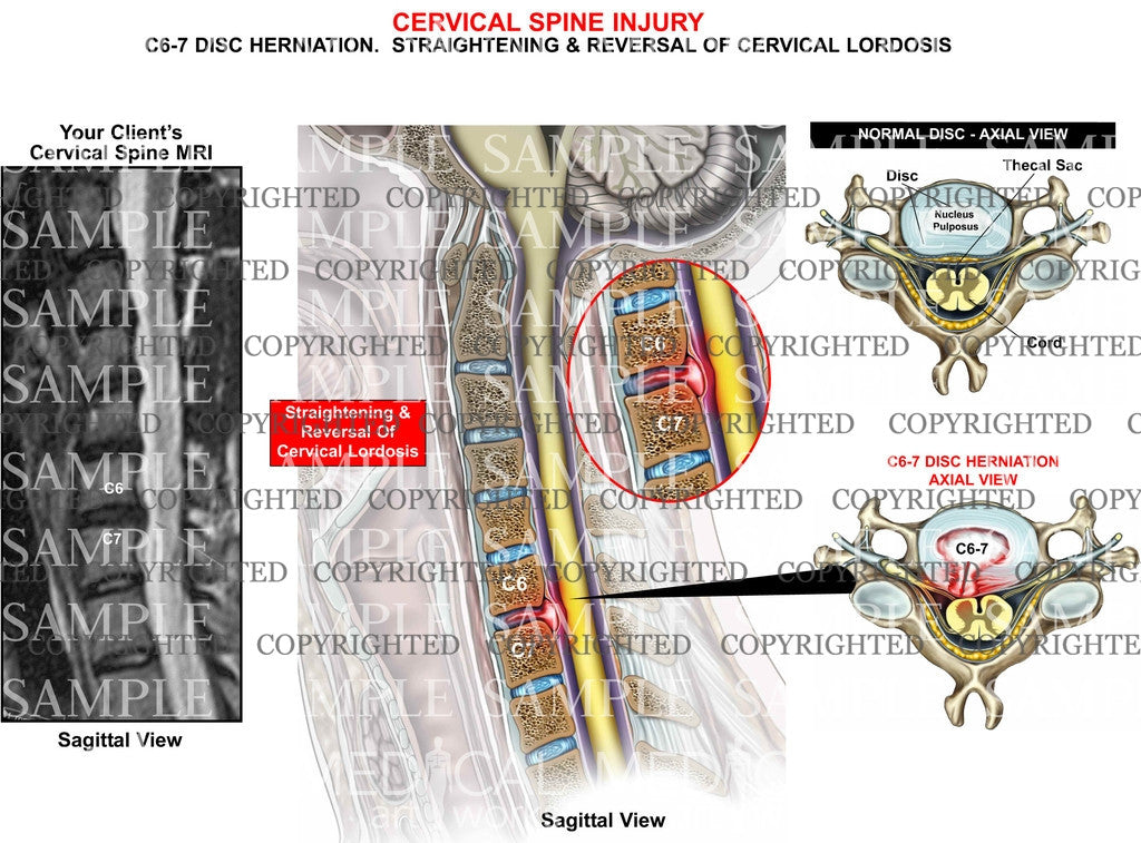 C6-7 disc herniation lordosis + MRI