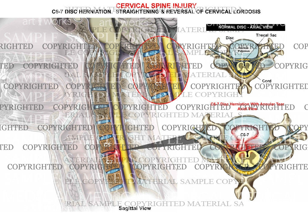 C6-7 disc herniation lordosis + axial