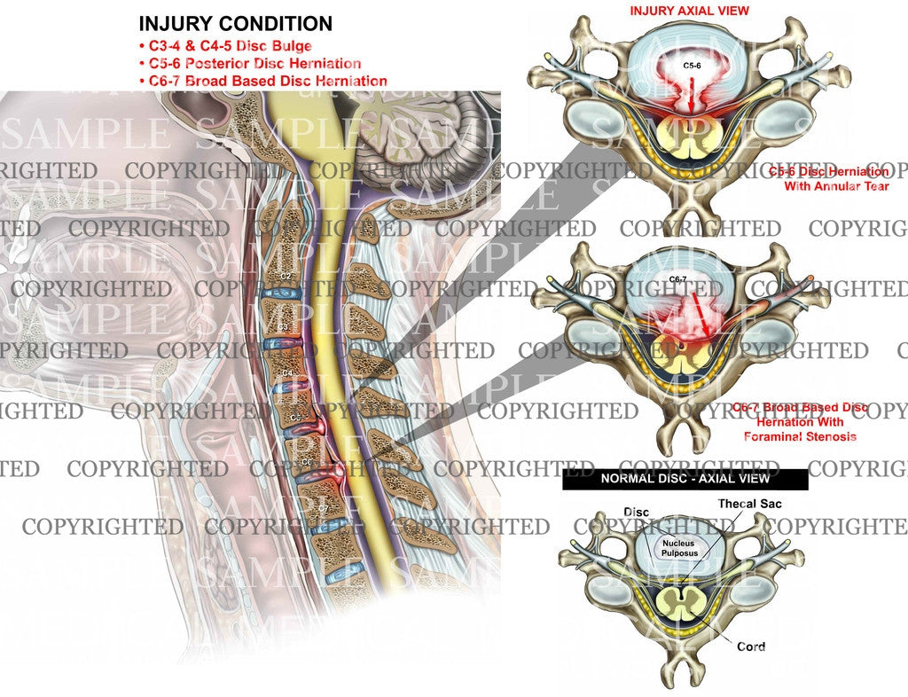 C5-6 & C6-7 disc herniation + C3-4, C4-5 bulges