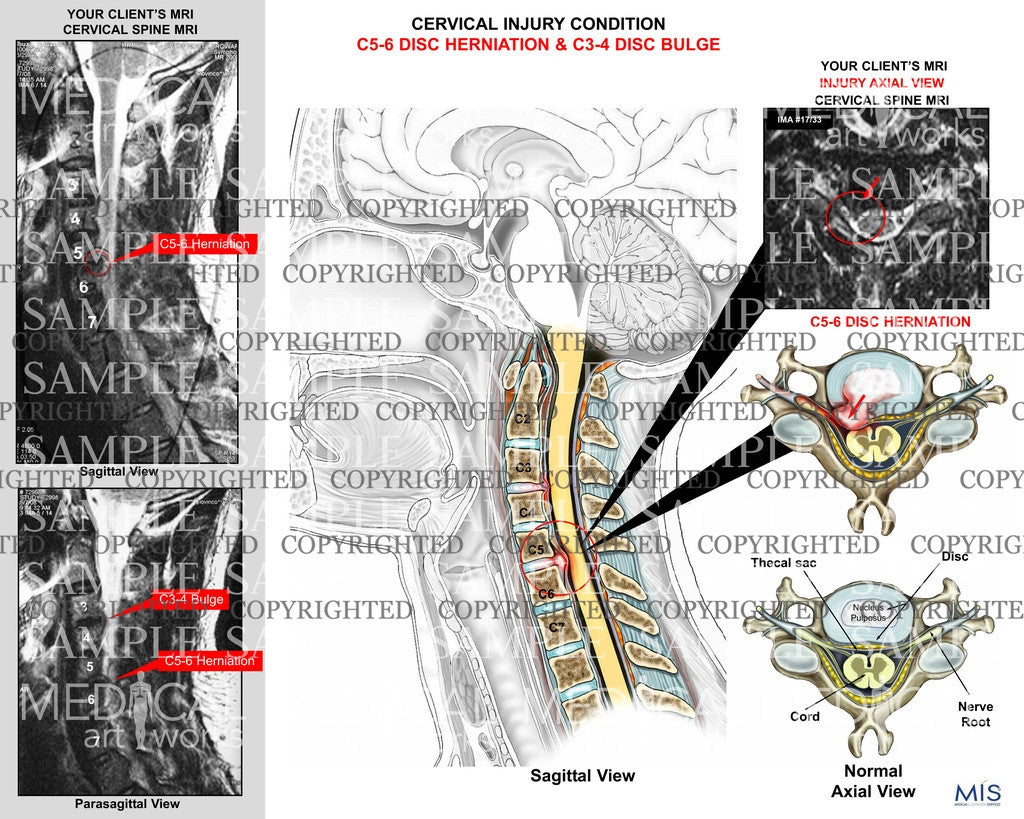 cervical disc herniation and disc bulge