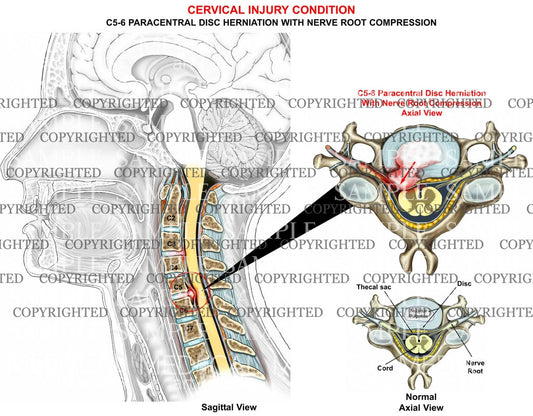 paracentral cervical disc herniation