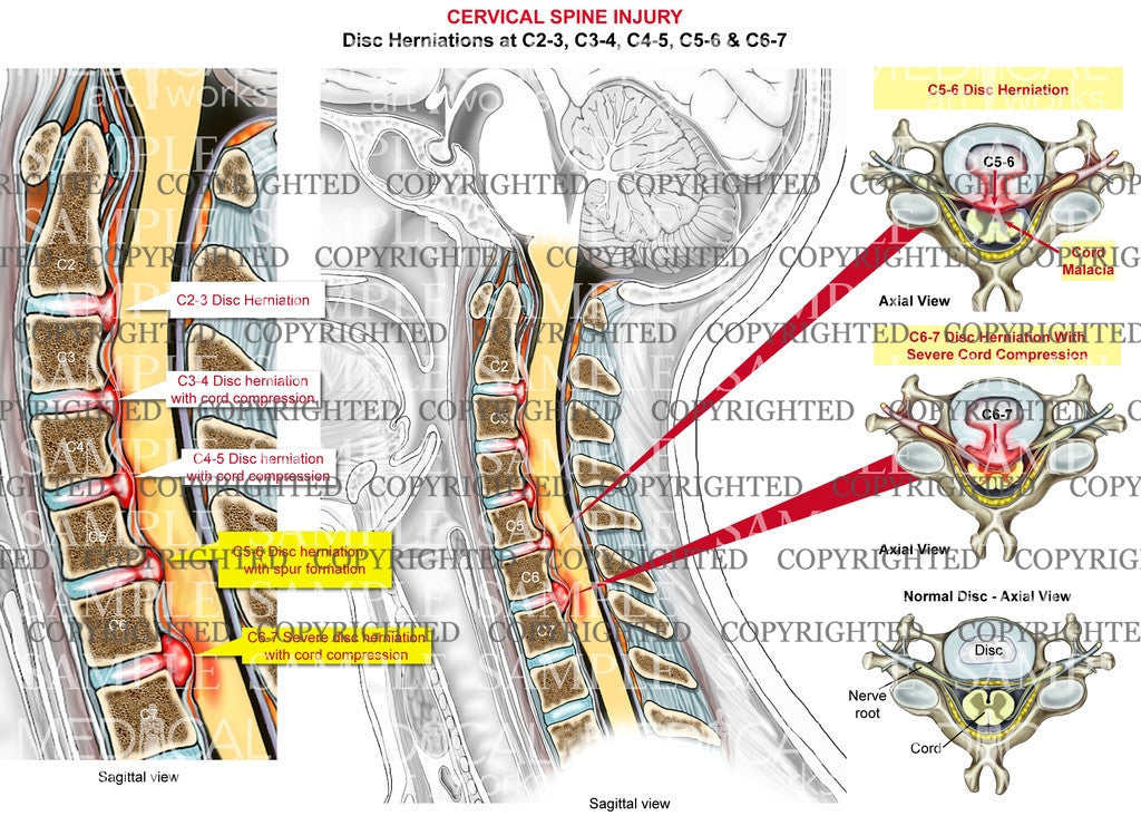 5 level - C2-C7 Cervical disc herniations