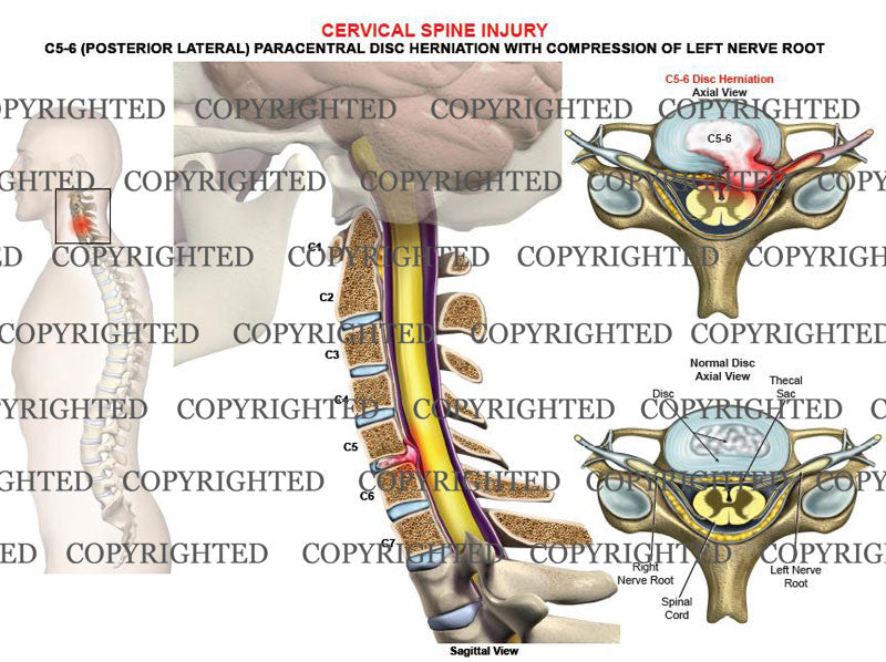 C5-6 left posterolateral, paracentral disc protrusion- male