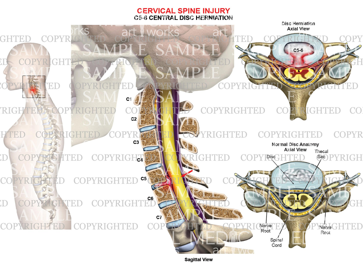 C5-6 disc herniation - central