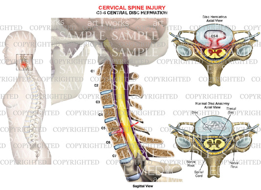 C5-6 disc herniation - central