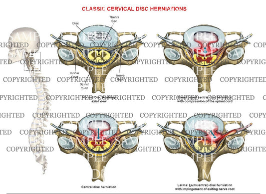 Types of cervical spine herniations