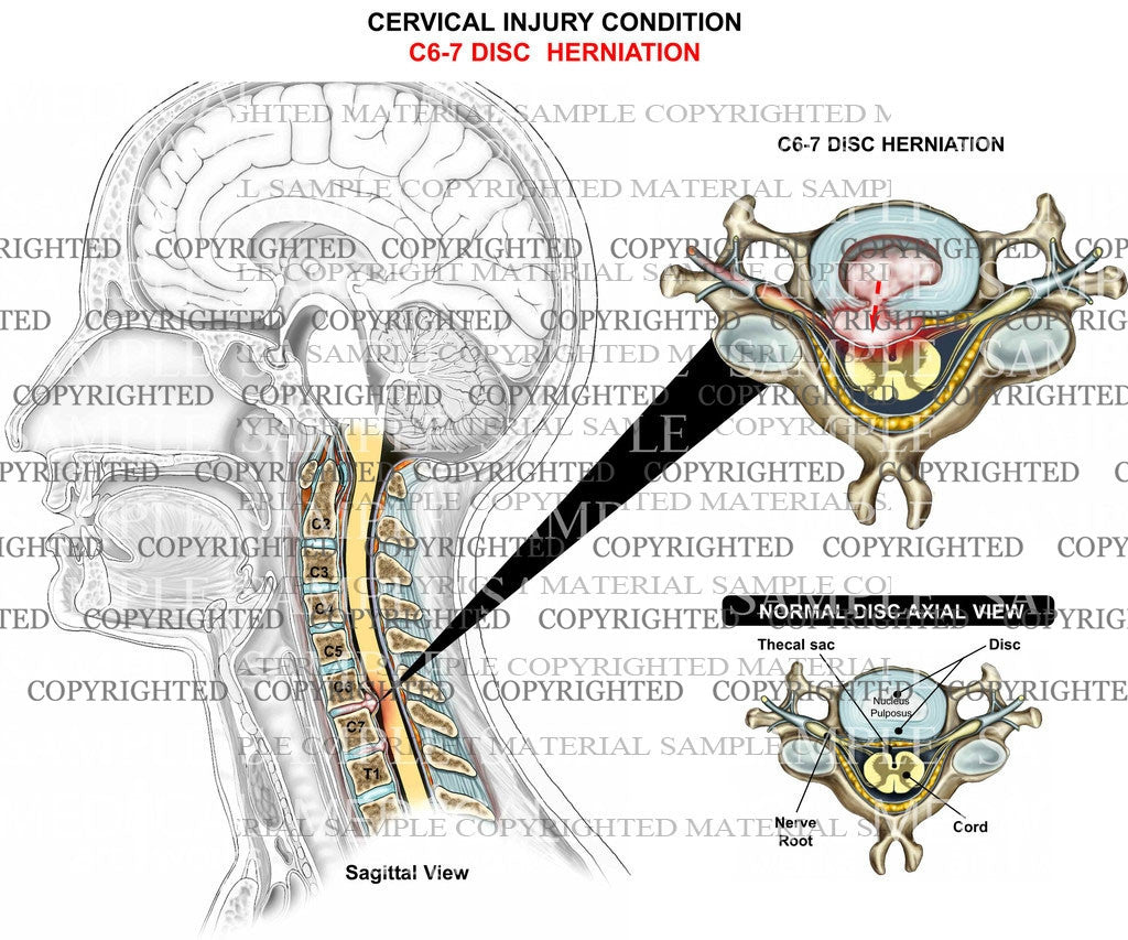 C6-7 disc herniation