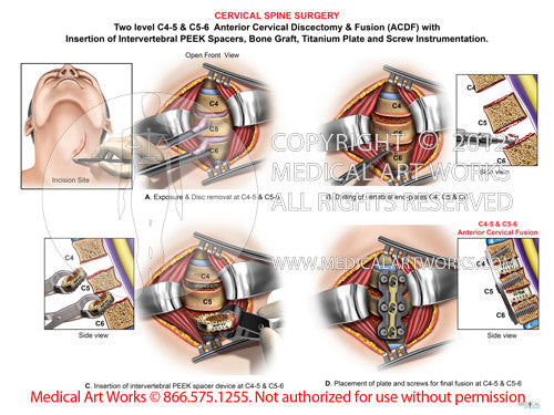 2 Level - C4-5 & C5-6 Anterior cervical discectomy and fusion. ACDF - Male - Right incision