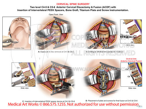 2 Level - C4-5 & C5-6 Anterior cervical discectomy and fusion. ACDF - Male - Left Incision