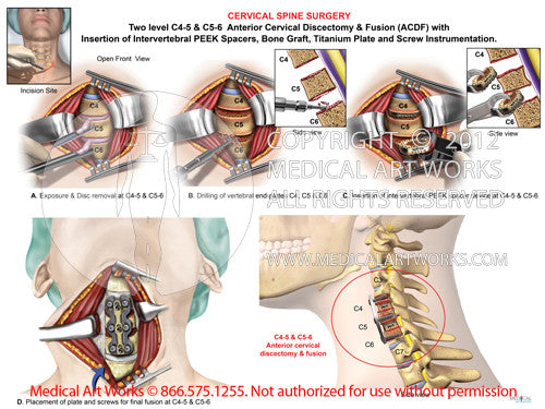 2 Level - C4-5 & C5-6 Anterior cervical discectomy and fusion. ACDF - Female