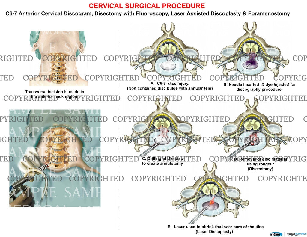 C6 7 Cervical Discogram Discoplasty Laser Medical Art Works