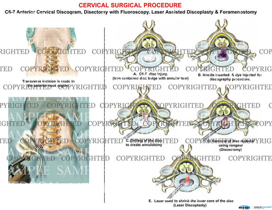 C6-7 cervical discogram + discoplasty laser