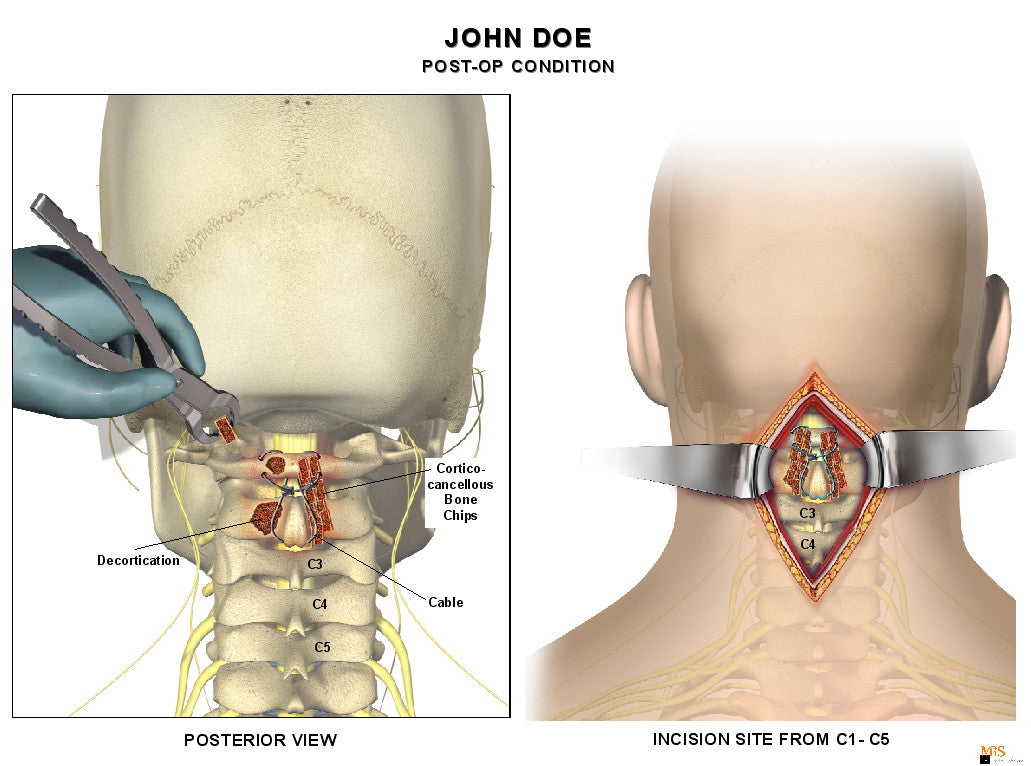 1 Level - C1-C2 Posterior cervical fusion with instrumentation