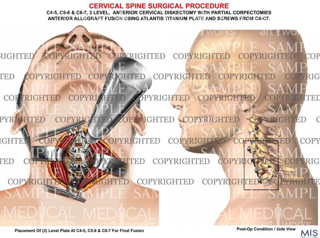 C4-5, C5-6 & C6-7 diskectomy + fusion - 3 level