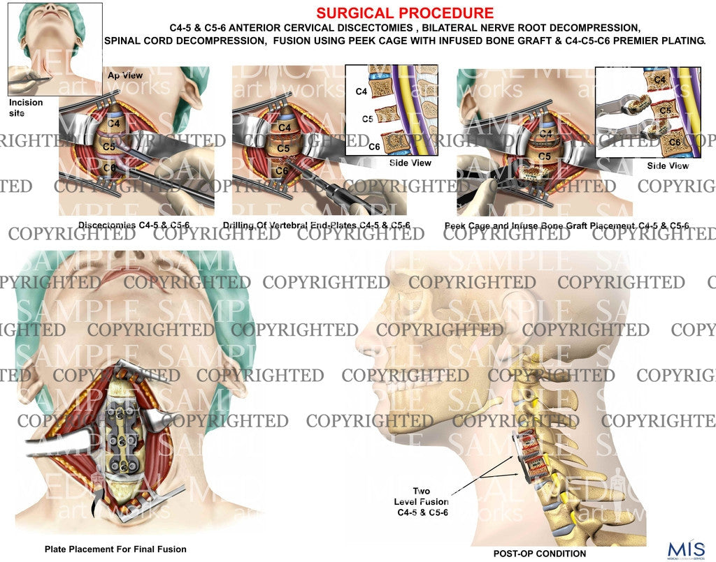 C4-5 and C5-6 cervical discectomy and fusion using peek cage