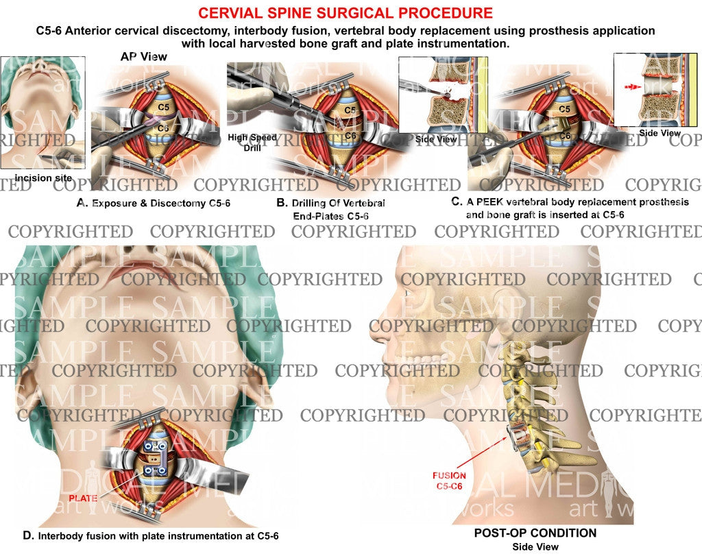 C5-6 anterior discectomy + interbody fusion -1 level