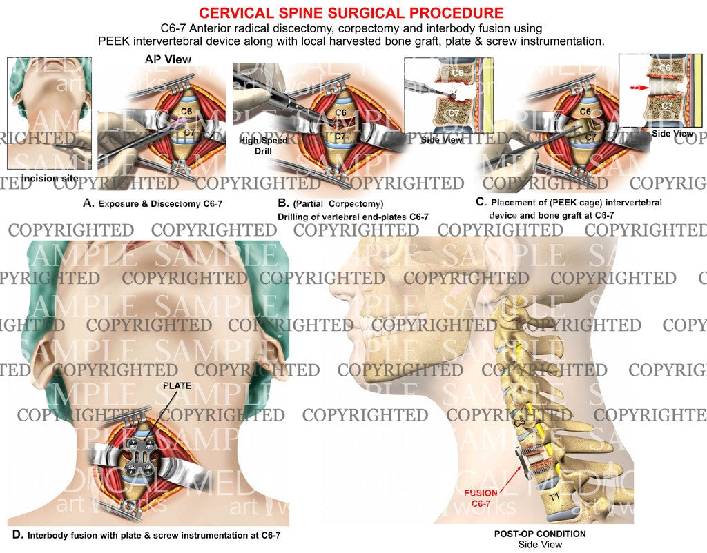 anterior radical discectomy, one level