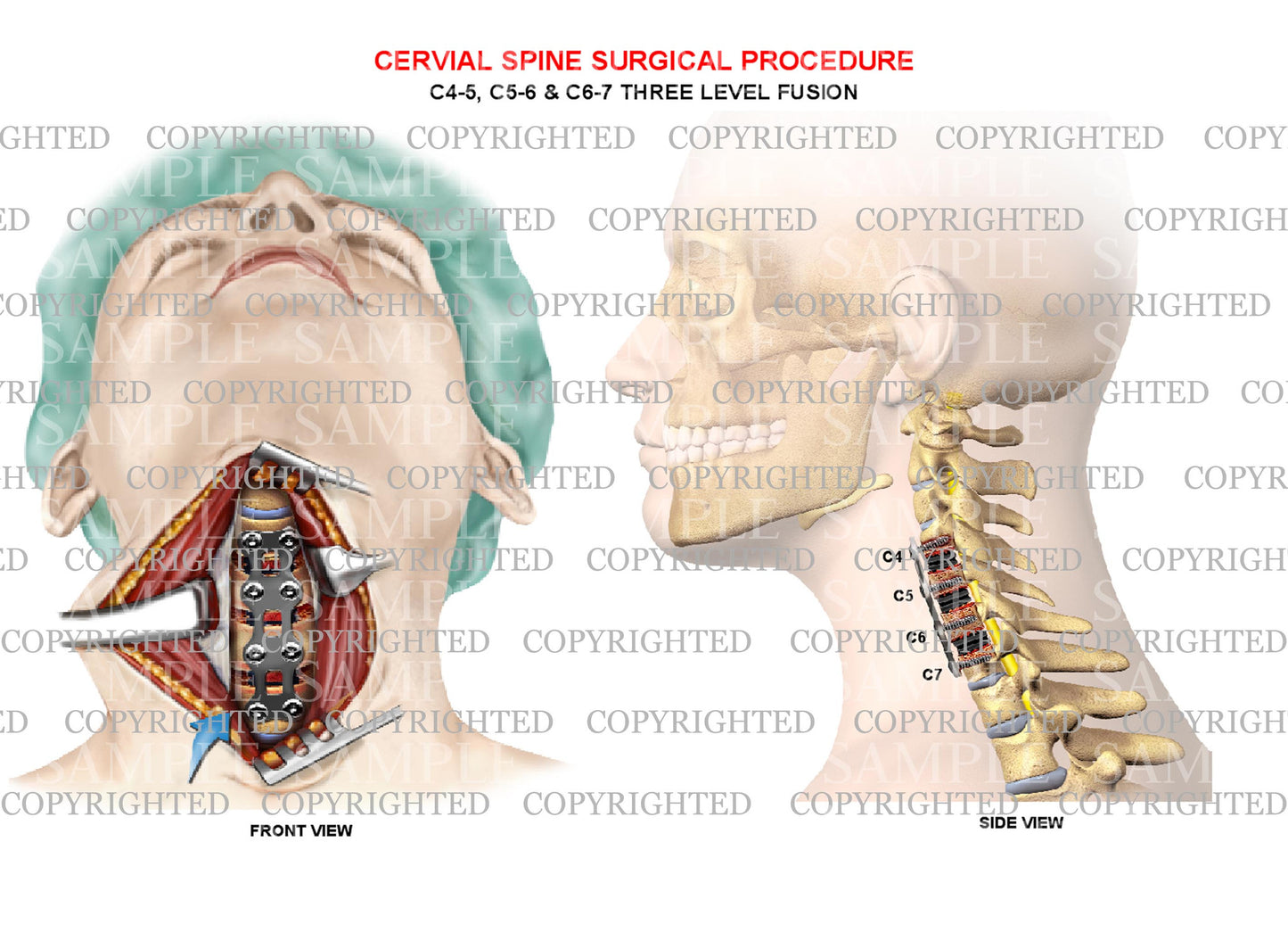 C4-C7 cervical plate fusion - 3 level