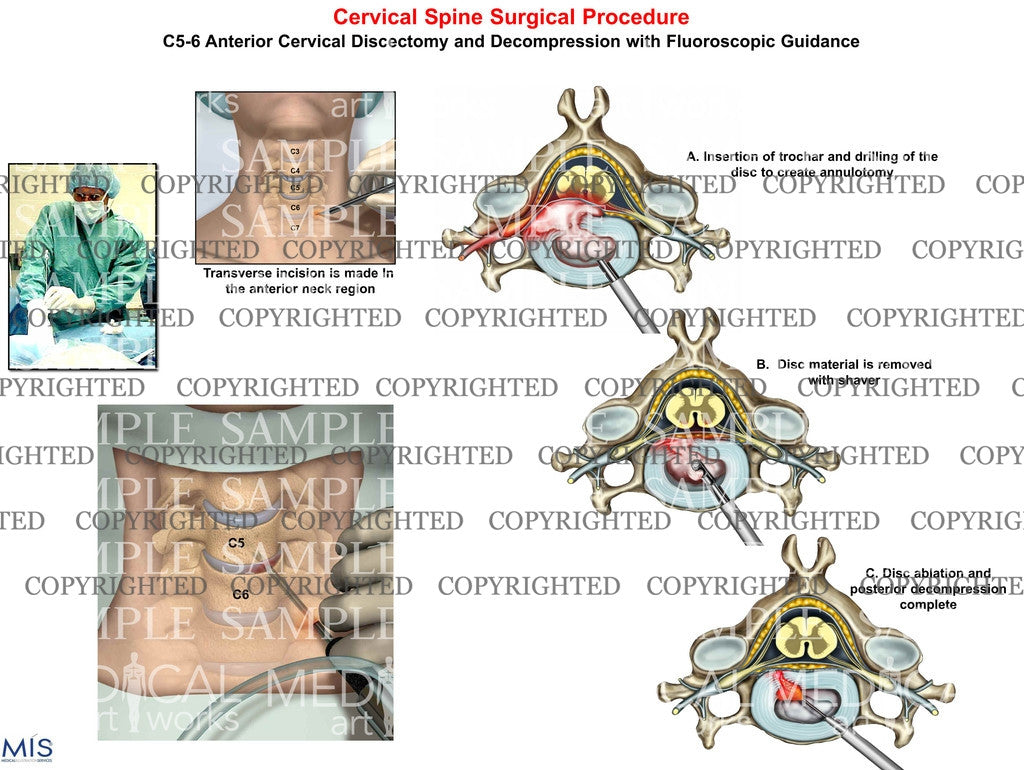 anterior cervical discectomy