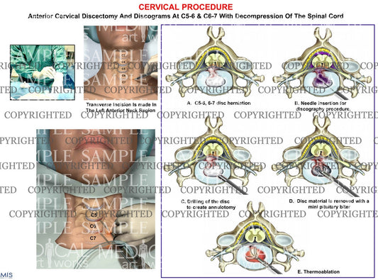 C5-6 & C6-7 anterior cervical discectomy + discogram