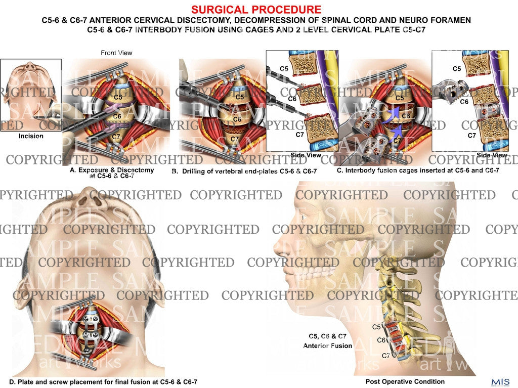 C5-6 & C6-7 discectomy + fusion - 2 level ACD