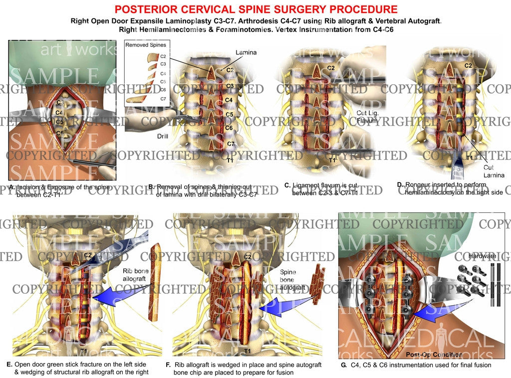 3 level - C3-C7 posterior cervical open door laminoplasty