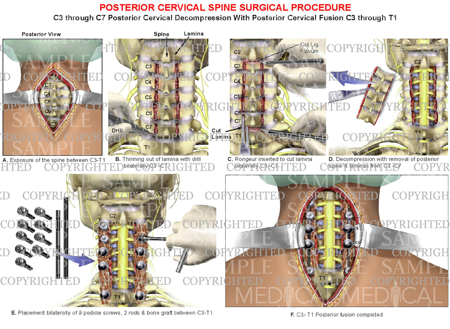 4 level - C3-C7 cervical spine decompression surgical procedure