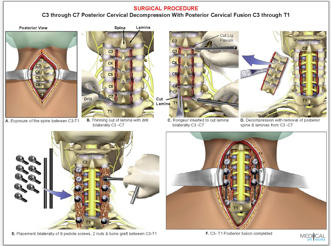 4 level - C3-C7 cervical spine decompression surgical procedure