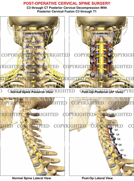 4  level - C3-C7 Post-op cervical spine decompression