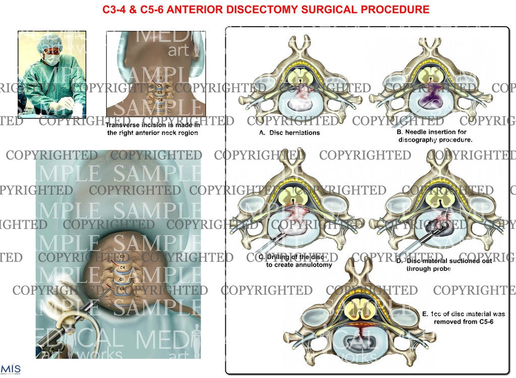 Cervical discectomy + fluoroscopic guidance