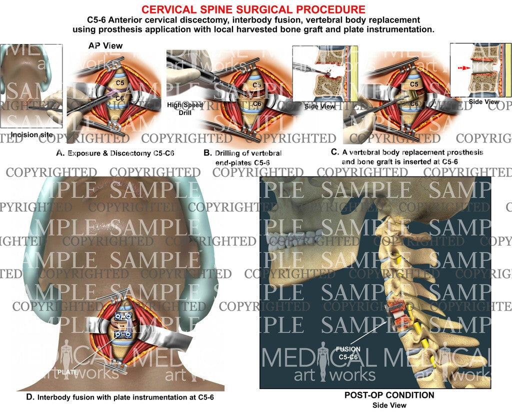 C5-6 anterior discectomy + interbody fusion2