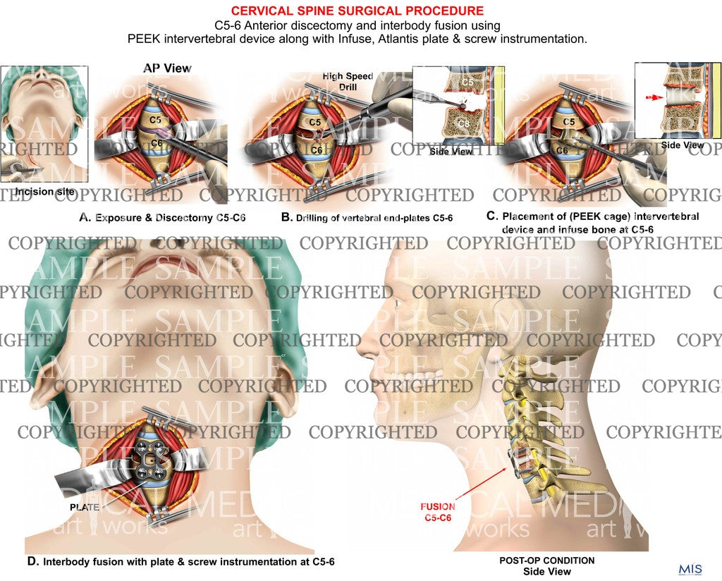 C5-6 anterior discectomy + interbody fusion